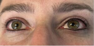 Hier ist der Wimpernkranz nach dem Pigmentieren zu sehen